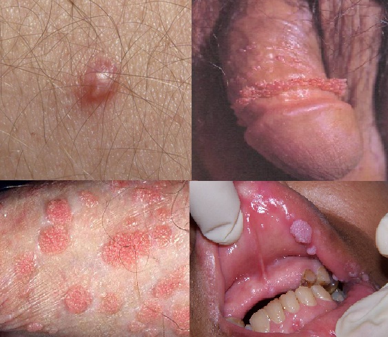 symptoms of genatal warts #11